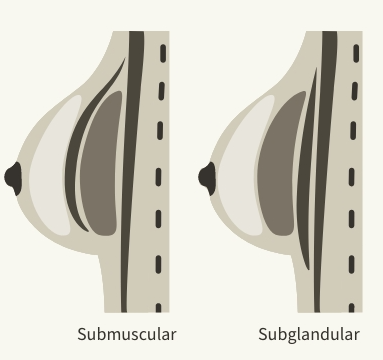 Graphic showing implant placements of either submuscular or subglandular